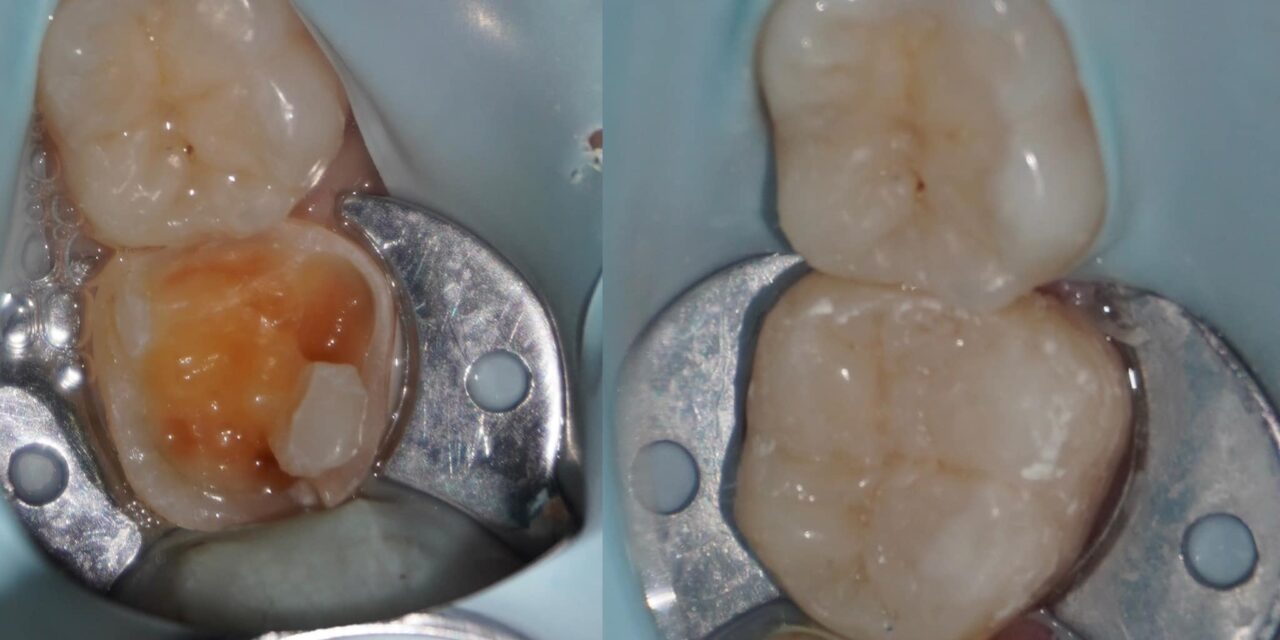 Direct restoration 37.